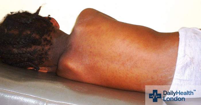 London vaccine uptake dips while measles clusters intensify